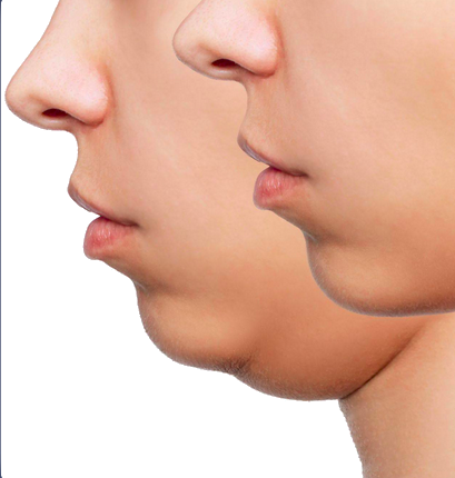 Cervicoplastia ou Remoção da Papada para um Contorno Facial Melhorado