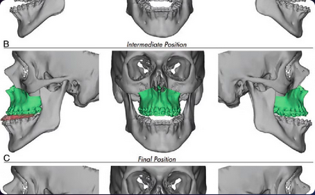 Cirurgia Ortognástica