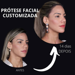 Implantes Faciais